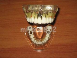   transparent pathologies implant model teeth from peru time left