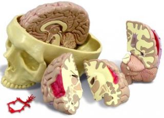 diseased human brain in skull anatomy model 2900 the diseased brain in 