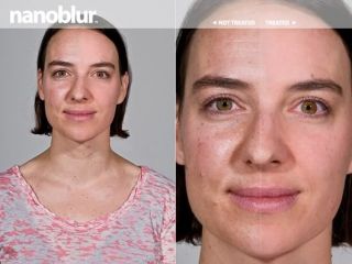 Nanoblur Acne Cream Treatment Melasma Skin Condition
