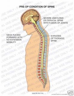 97232A24A Cervical Thoracic Spine Ankylosis Kyphosis